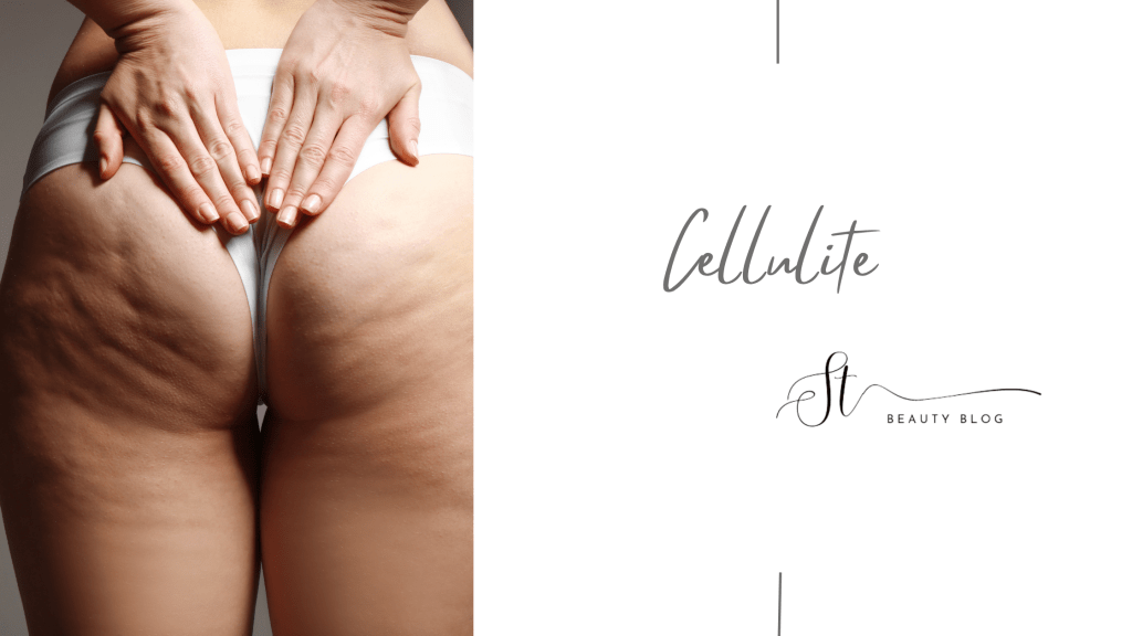 How to Reduce&nbsp;Cellulite